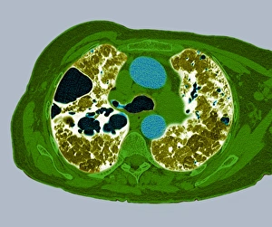 Lung fibrosis, CT scan Lung fibrosis, CT scan