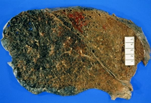 Lung specimen diseased with emphysema Lung specimen diseased with emphysema