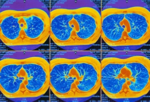Lungs, CT scans Lungs, CT scans