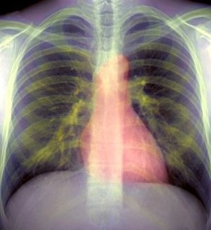 Lungs and heart, X-ray Lungs and heart, X-ray
