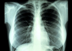 Human Respiratory System Anatomy Prints: Lungs, X-ray