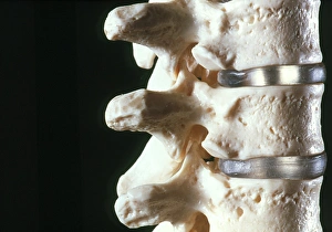 Model of three vertebrae and intervertebral discs Model of three vertebrae and intervertebral discs