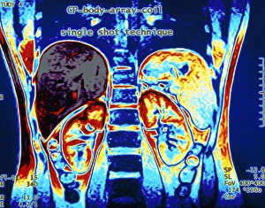 MRI scan of human abdomen showing kidneys & liver MRI scan of human abdomen showing kidneys & liver
