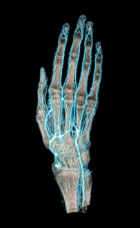 Prints of Mummified hand. Coloured angiogram of an embalmed hand, showing the preserved and intact blood vessels Images Dated 2004 December: Mummified Hand Print: Coloured Angiogram of Embalmed Hand