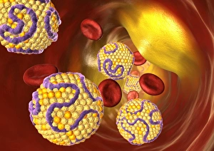 Prints of Narrowed artery. Computer artwork of a narrowed artery, showing red blood cells (red) and high levels of low density lipoprotein (LDL, yellow balls) Images Dated 2008 March: Narrowed artery print