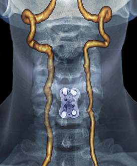 Neck arthritis treatment, angiogram C016/6440 Neck arthritis treatment, angiogram C016/6440