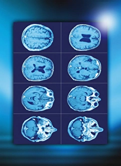 Prints of Normal brain. Coloured axial (cross-sectional) computed tomography (CT) scans of a healthy human head. The front of the head is at right in each scan Images Dated 2008 June: Normal Brain CT Scan Print - Coloured Axial Cross-Sectional Views