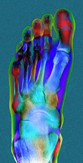 Coloured X-ray Print of a Normal Foot