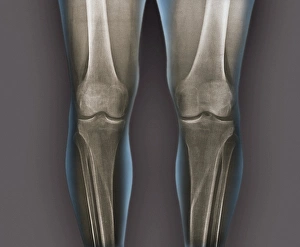 Prints of Normal knees. Coloured frontal X-rays of the healthy knees of a 35-year-old Images Dated 2013 April: Coloured frontal X-rays Print of healthy knees
