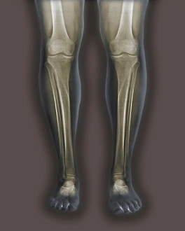 Normal legs, X-rays