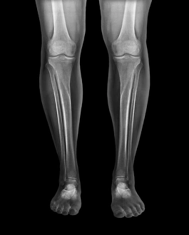 Xray Prints: Coloured frontal X-ray Print of Normal Legs