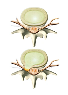 Prints of Normal and slipped disc. Artwork showing a normal (top) and slipped (bottom) disc in the backbone, seen from above Images Dated 2011 July: Normal and Slipped Disc Print