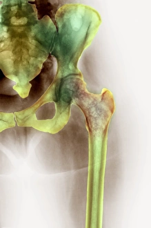 Osteoporosis of the hip, X-ray Osteoporosis of the hip, X-ray