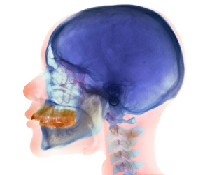 Prints of Overbite. Coloured X-ray (side view) of the head of a 32 year old woman showing overbite of the upper jaw (yellow) and its teeth Images Dated 2006 November: Coloured X-ray Print of Overbite
