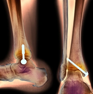 Pinned ankle fracture, two views, X-ray Pinned ankle fracture, two views, X-ray
