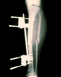 Images Dated 5th December 2002: X-ray Print of Pinned Broken Leg