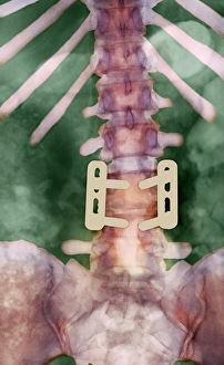 Pinned vertebrae, X-ray Pinned vertebrae, X-ray