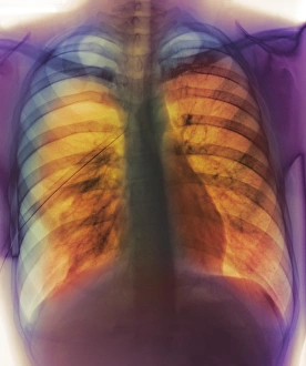 Pneumothorax Pneumothorax