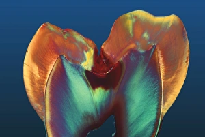 Polarised LM of a molar tooth showing decay Polarised LM of a molar tooth showing decay