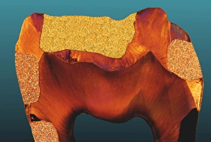 Polarised LM of a tooth with various fillings Polarised LM of a tooth with various fillings