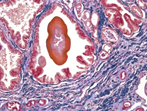 Prints of Prostate. Light micrograph of a section through a prostate showing a concretion (red) of secretory materials in a prostatic alveolus (air space) Images Dated 2010 September: Prostate Print, x100 magnification