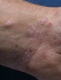 Prints of Psoriasis lesions on the skin of a mans wrist Images Dated 2003 June: Psoriasis Print: Scaly patches on a man's wrist
