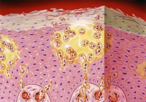 Section through skin in pustular psoriasis Print