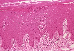 Psoriasis, light micrograph Psoriasis, light micrograph