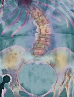 Scoliosis spine deformity, X-ray Scoliosis spine deformity, X-ray