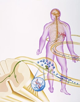 Prints of Shingles nerve damage Images Dated 2003 March: Shingles Nerve Damage Print