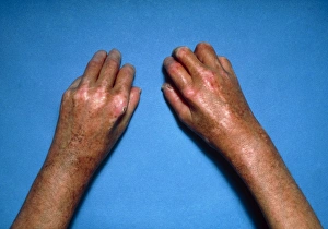 Shiny toughened skin on hands due to scleroderma Shiny toughened skin on hands due to scleroderma
