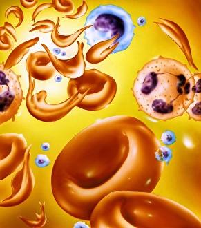 Sickle cell anaemia Sickle cell anaemia
