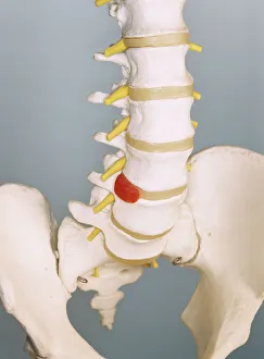 Prints of Slipped disc. Spinal model demonstrating a slipped intervertebral disc. The slipped disc is the small bulge (red, centre), near the base of the spine Images Dated 2004 August: Slipped Disc Print: Spinal Model