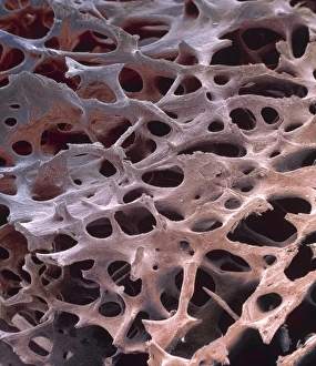 Prints of Spongy bone. Coloured scanning electron micrograph (SEM) of human spongy (cancellous) bone from the shaft of a long bone Images Dated 2002 March: Spongy bone Print: Coloured SEM of human cancellous bone structure
