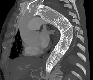 Stent to treat aortic aneurysm, CT scan Stent to treat aortic aneurysm, CT scan