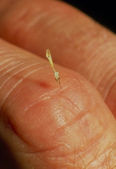 Sting of a honeybee embedded in a human finger Sting of a honeybee embedded in a human finger