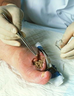 Surgeon placing maggots in a wound to clean it Surgeon placing maggots in a wound to clean it