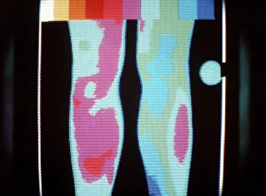 Thermogram of legs showing deep vein thrombosis Thermogram of legs showing deep vein thrombosis