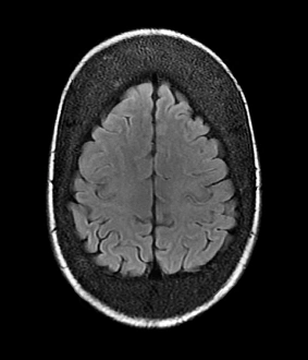 Prints of Thickened skull. Magnetic resonance imaging (MRI) scan of an axial section through the head of a 22-year-old patient, showing thickening of the trabecular (spongy) bone of the skull Images Dated 2013 April: Thickened Skull MRI Scan Print