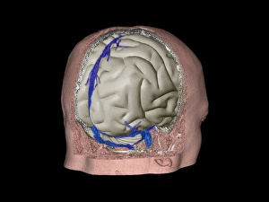 Thrombophlebitis in the brain, 3D CT scan Thrombophlebitis in the brain, 3D CT scan