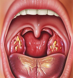 Tonsillitis Tonsillitis