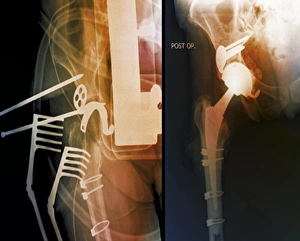 Hip Replacement Surgery Prints: Total hip replacement, X-rays