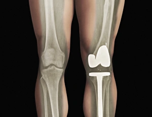 Images Dated 27th March 2013: Total Knee Replacement Print, X-ray of Left Leg
