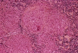 Mycobacterium Tuberculosis Bacteria Prints: Tuberculosis, light micrograph C015 / 6400