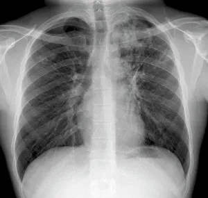 X-ray Print of Pulmonary Tuberculosis