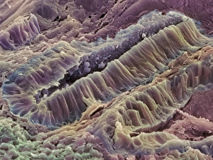 Ulcerative colitis, SEM Ulcerative colitis, SEM