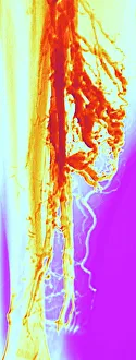 Varicose veins, X-ray Varicose veins, X-ray