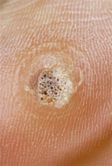 Prints of A verruca (or plantar wart), a small benign growth in the skin caused by a virus infection Images Dated 2004 November: Verruca Print: Plantar Wart Growth