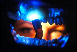 View from inside the mouth of dental crown fitting View from inside the mouth of dental crown fitting