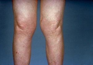 View of knees affected by osteoarthritis View of knees affected by osteoarthritis